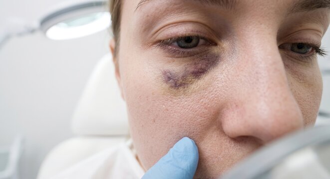 Close examination of dark purple eye bruise hematoma on female patient face