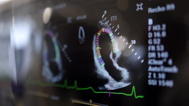 Echocardiography screen showing heart structure and function during cardiac diagnostic imaging.