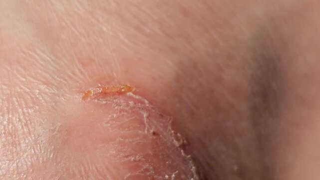 Macro view of a deep painful fissure on severely dry and cracked human skin, showing a thick rough callus with peeling epidermis, illustrating dermatological issues like extreme heel dryness