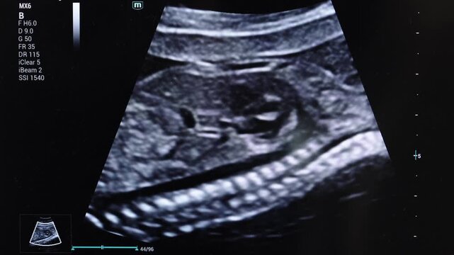 Prenatal ultrasound diagnostics with an image of a developing fetus on a medical monitor.