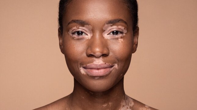 Natural Beauty Portrait of Woman With Vitiligo Skin Patterns