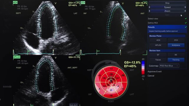 Medical screen showing echocardiography results for evaluation of heart structure and function.