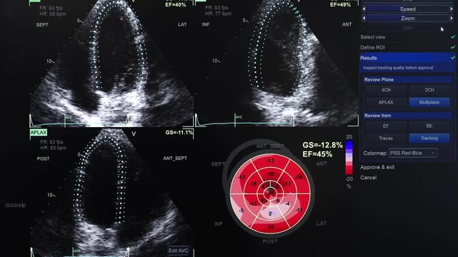 Medical monitor showing cardiac ultrasound results, measurements and assessment of myocardial function.