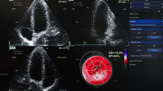Heart ultrasound with myocardial contraction analysis and color diagnostic map displayed on an echocardiography screen.