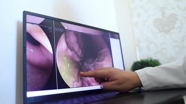 Gastroenterologist doctor examining endoscopy endoscopy results on a laptop showing bile reflux in the stomach. Specialist explaining gastroscopy stomach diagnosis during medical consultation.