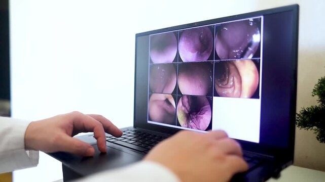 Gastroenterologist doctor examining endoscopy endoscopy results on a laptop showing bile reflux in the stomach. Specialist explaining gastroscopy stomach diagnosis during medical consultation.