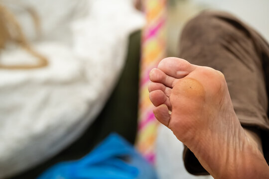 Close up of human foot sole showing painful callus and dry skin