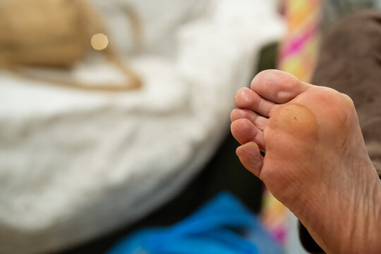 Close up of human foot sole showing painful callus and dry skin