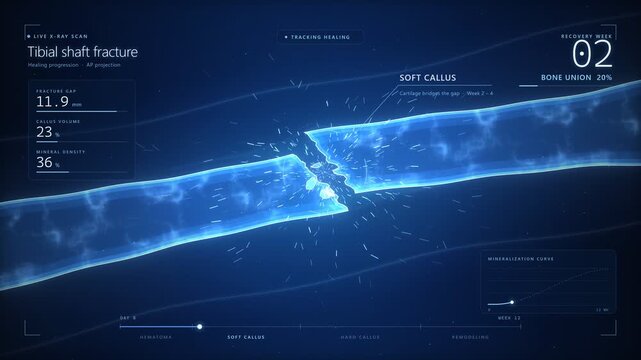 Medical X Ray Animation of Tibial Shaft Fracture Healing Process