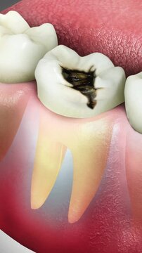 Root canal infection, pain and sensation: A Close View.	