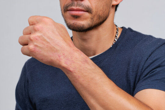Mild red skin rash on the forearm of a young man with allergic dermatitis