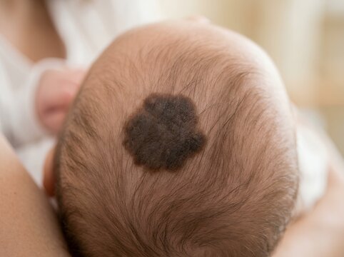 Close up of baby scalp skin patch showing pigmentation anomaly or birthmark condition dermatology concern
