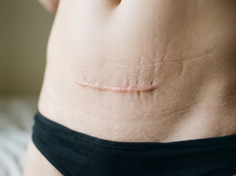 Close up view of abdominal skin with surgical scar healing and body anatomy detail