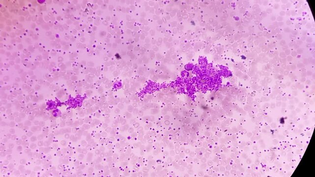 Thrombocytosis. Platelet increased in number. Microscopic footage of complete blood count (CBC). 