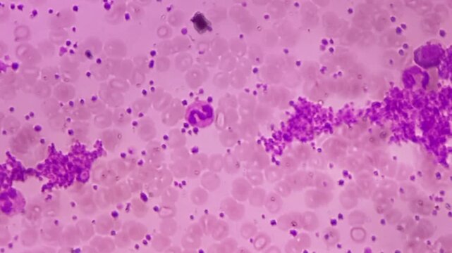 Thrombocytosis. Platelet increased in number. Microscopic footage of complete blood count (CBC). 