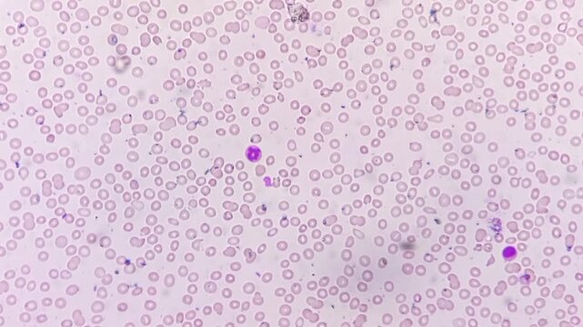 Acute leukaemia (AL). Microscopic footage. WBC shows left shift, atypical looking large mononuclear cells with 1-2 nucleoli.