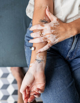 Woman with vitiligo showing tattooed hands and arms