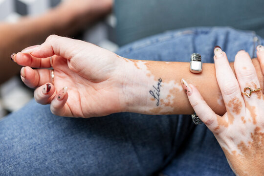 Close up of hands with vitiligo and tattoo