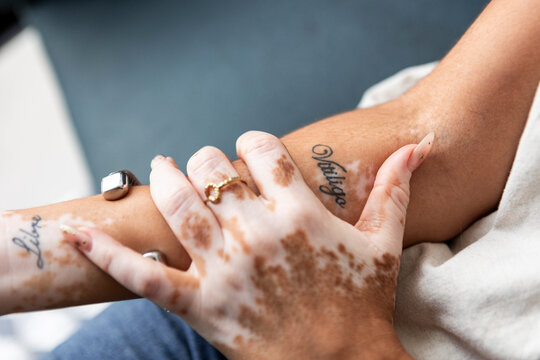 Woman with vitiligo tattoos embracing her forearm