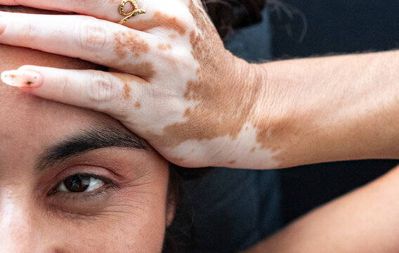 Woman with vitiligo covering forehead in close-up portrait