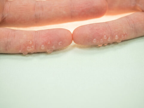 Dyshidrotic eczema blisters shown as tiny dew drops along finger sides