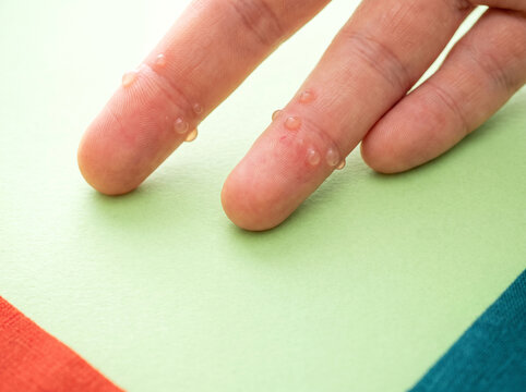 Dyshidrotic eczema blisters shown as tiny dew drops along finger sides