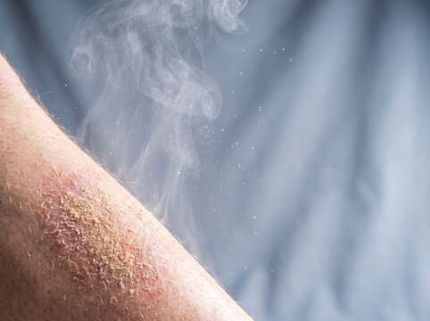 Moisture loss concept, water vapour escaping from a dry skin patch