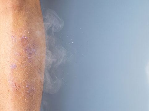 Moisture loss concept, water vapour escaping from a dry skin patch