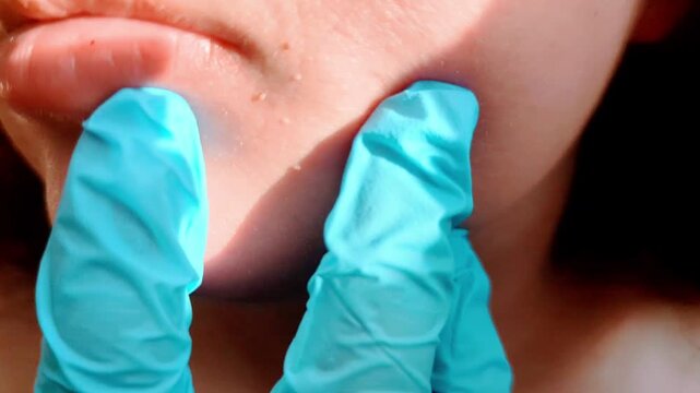 Bad skin .
Skin showing blackheads, pimples, papillomas, dry and rough patches after illness. Reflects a condition needing care and recovery.

