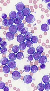 Microscopic View of Blood Cells Leukemia Cells and Red Blood Cells