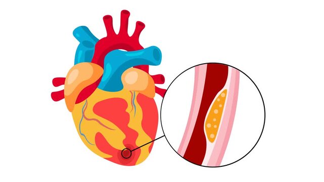 Medical vector animation displaying human heart anatomy with a magnified cross-section of coronary artery occlusion caused by atherosclerotic plaque buildup, highlighting cardiac arrest, myocardial 