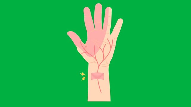 Medical vector animation displaying human hand and wrist anatomy illustrating median nerve entrapment beneath the transverse carpal ligament with radiating sensory numbness, highlighting carpal tunnel