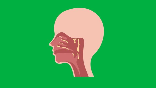Medical vector animation displaying a sagittal cross-section of human head and neck anatomy with excessive mucus accumulation in the nasal passages and throat, highlighting catarrh, chronic sinusitis