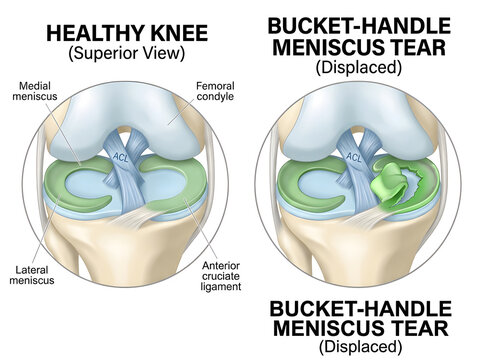 Healthy knee vs bucket-handle meniscus tear illustration isolated on white background