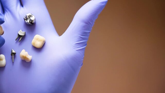 Gloved Palm Displaying Assorted Dental Crowns And Implant Posts