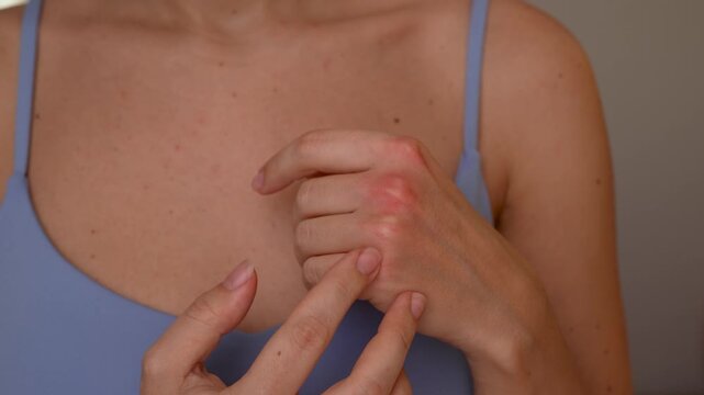 Young woman demonstrates red irritated knuckles on the outer side of her hand, highlighting allergy, dermatitis, and visible skin inflammation