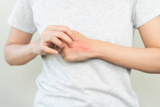 Dermatology asian young woman allergy, allergic reaction from atopic, insect bite, scratching itchy back of hand, red spot or rash of skin. Healthcare treatment of beauty. Isolated on white background