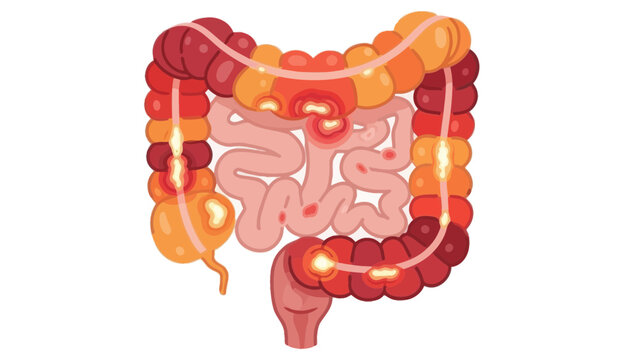 Human Intestinal Anatomy Showing Inflammation and Irritation