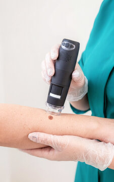 Dermatologist examining mole on patient arm with digital dermatoscope, skin cancer screening and nevus inspection close up