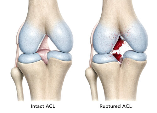 Medical illustration showing intact and ruptured anterior cruciate ligament in knee joint