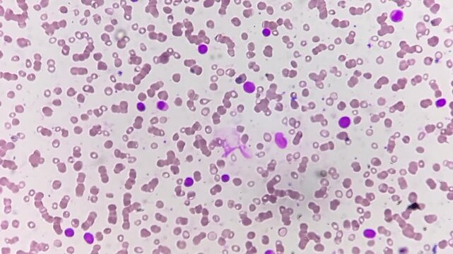Acute leukaemia (AL). Microscopic footage. WBC shows left shift, predominant cells are atypical looking mononuclear cells with large nuclear, scanty cytoplasm, loose chromatin, 1-2 nucleoli.