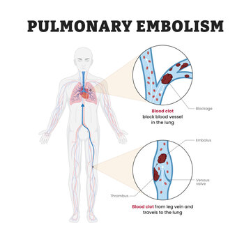 Pulmonary Embolism labeled diagram, educational cardiovascular poster design, blood clot migration and pulmonary vessel blockage. Labeled blood clot, blockage, embolus, thrombus, venous valve