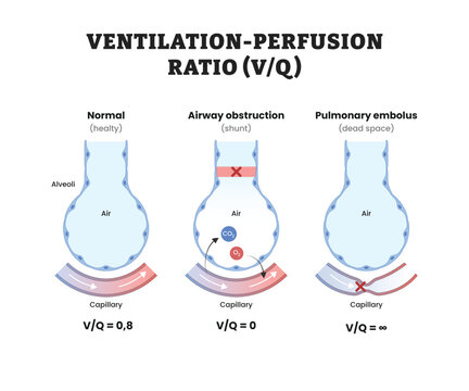 Ventilation-Perfusion Ratio labeled diagram, educational respiratory physiology poster design, airflow and blood flow relationships in the lungs. Labeled normal, airway obstruction, pulmonary embolus