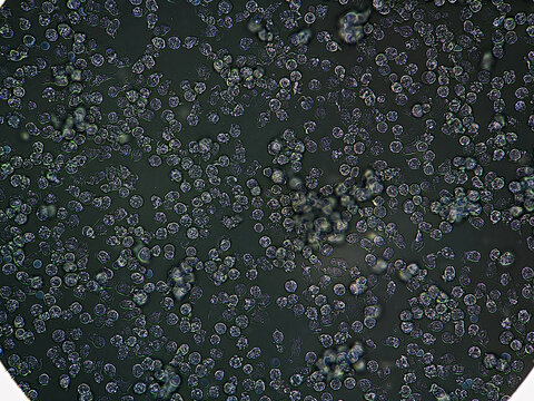 Microscopic urinalysis seen plenty pus cells. Plenty pus cells in urine under microscope.  