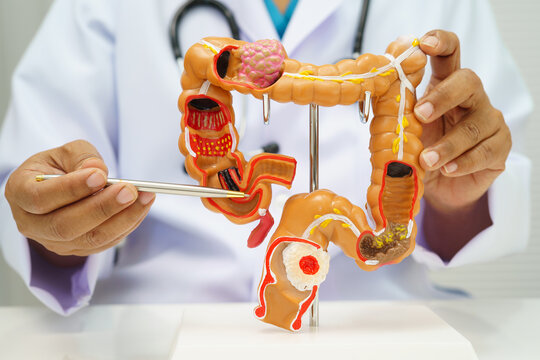 Colorectal cancer, doctor holding intestine colon human anatomy model.