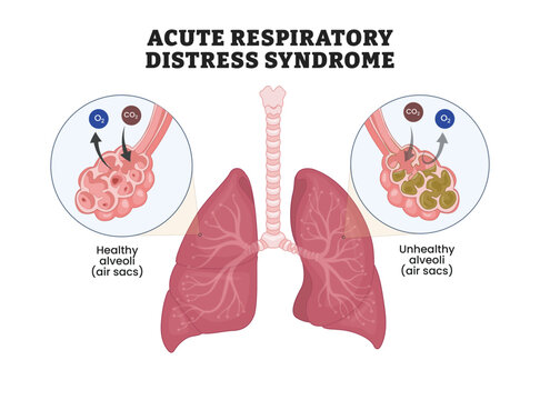 Acute Respiratory Distress Syndrome labeled diagram, educational respiratory poster design, alveolar damage and impaired gas exchange. Labeled healthy alveoli, unhealthy alveoli, O2, CO2, lungs