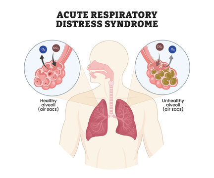 Acute Respiratory Distress Syndrome labeled diagram, educational respiratory poster design, alveolar damage and impaired gas exchange. Labeled healthy alveoli, unhealthy alveoli, O2, CO2, lungs