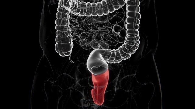 Pouchitis is inflammation of an intestinal pouch created during surgery, most commonly an ileal pouch formed after removal of the colon and rectum in UHD 4K video