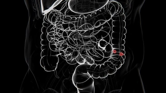 A colon polyp is a growth that develops on the inner lining of the colon and may vary in size, shape, and tissue type in 4K UHD Video