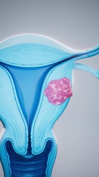 Conceptual 3D animation of a uterine fibroid and uterine anatomy
